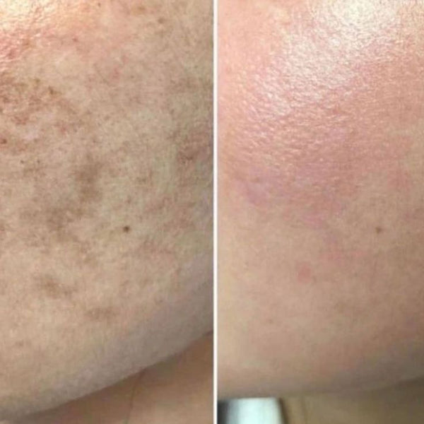 Pigmentation