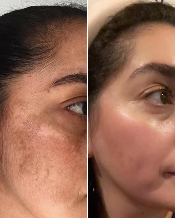 uneven skin tone